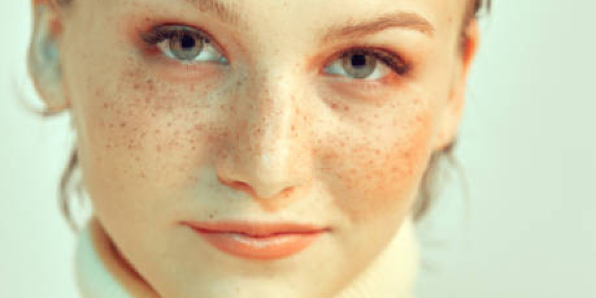 How to Prepare for Treatment for Removing Birthmarks