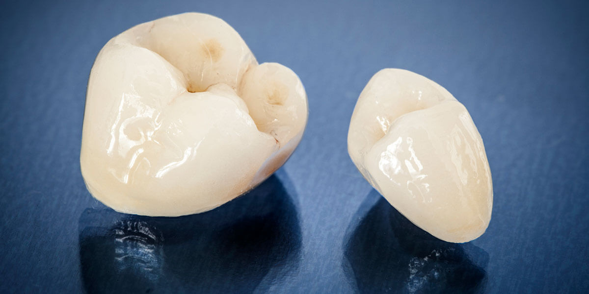 Everything You Need to Know about Dental Crowns: From Treatment to Aesthetics