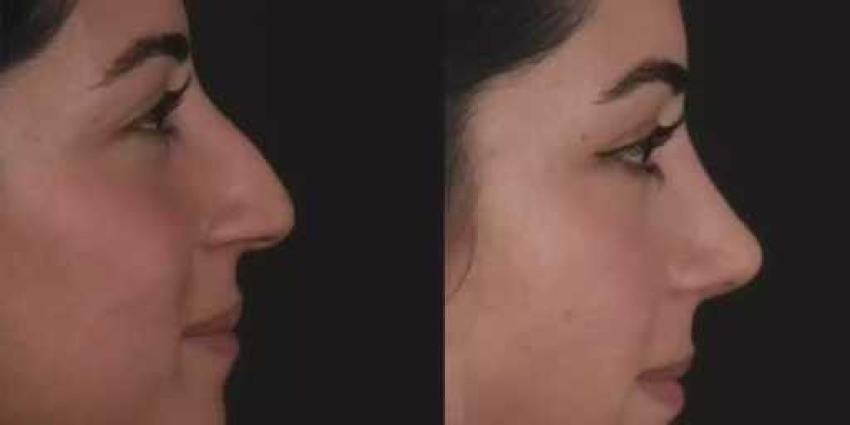 Septoplasty in Dubai: Evidence-Based Care for Nasal Deviations