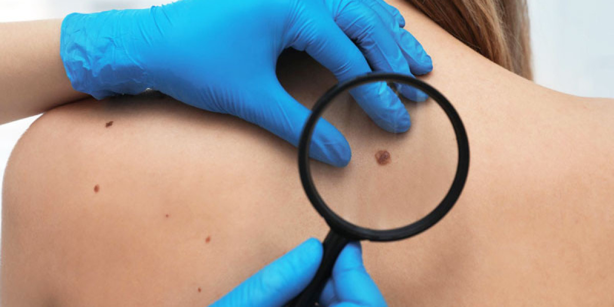Skin Tag Removal in Delhi : Dermatologist-Approved Solutions for Skin Tags