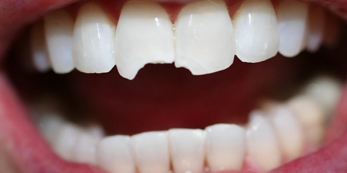 Teeth Fracture Treatment in Islamabad | Pain-Free Solutions