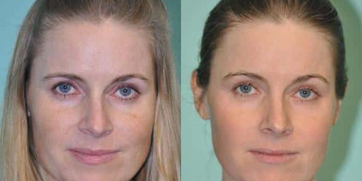 Erbium Laser Skin Resurfacing Daytona Beach