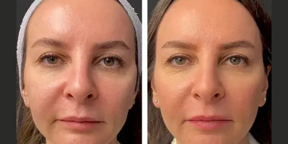 Mesotherapy Treatments in Dubai for Bridal Skin Preparation