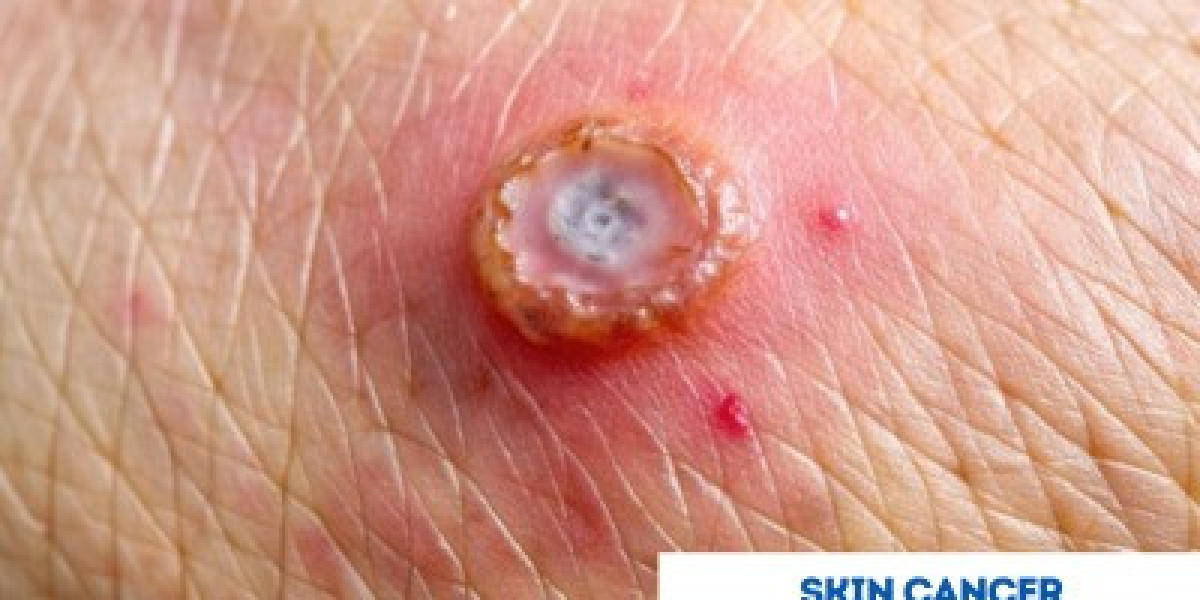 Affordable Skin Cancer Treatment in India with Comprehensive Cancer Care