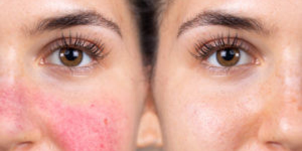 Rosacea Laser Treatment Explained: How Laser Treatments for Rosacea Improve Redness