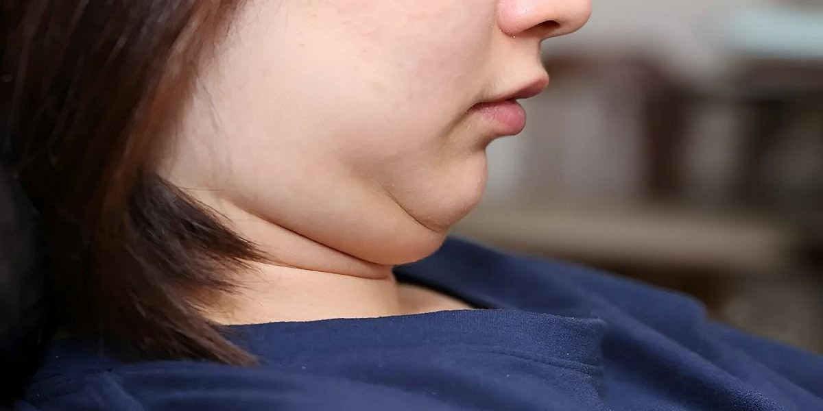 Double Chin Liposuction in Islamabad for Jaw Harmony
