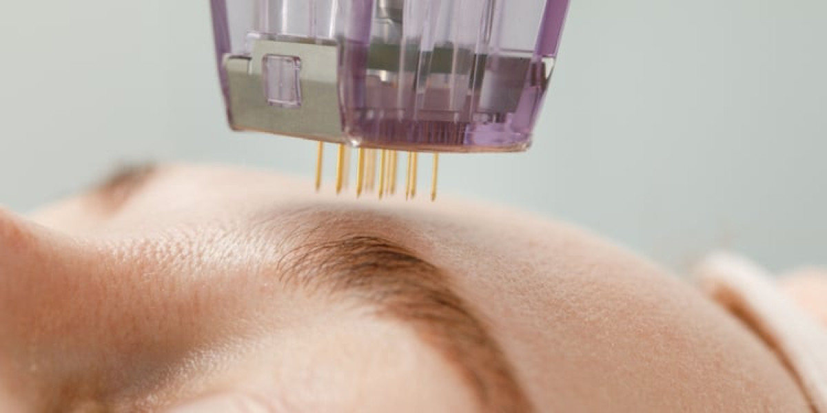How Many RF Microneedling Sessions Are Needed for Visible Results?