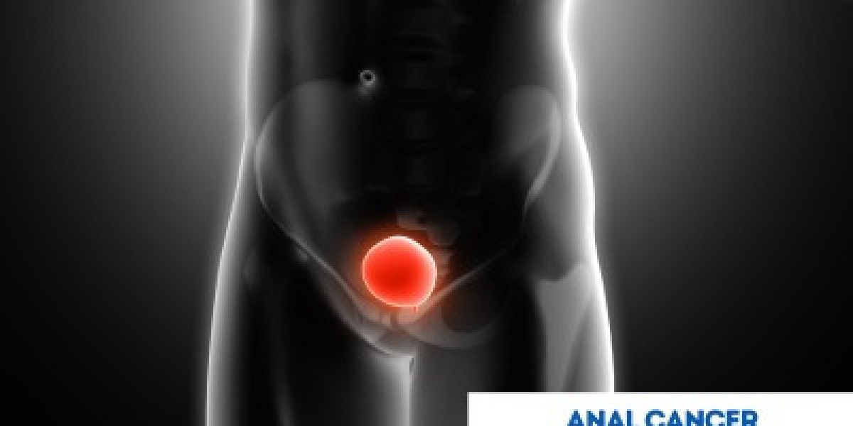 Choosing India for Anal Cancer Treatment: Quality Oncology Care at Affordable Costs