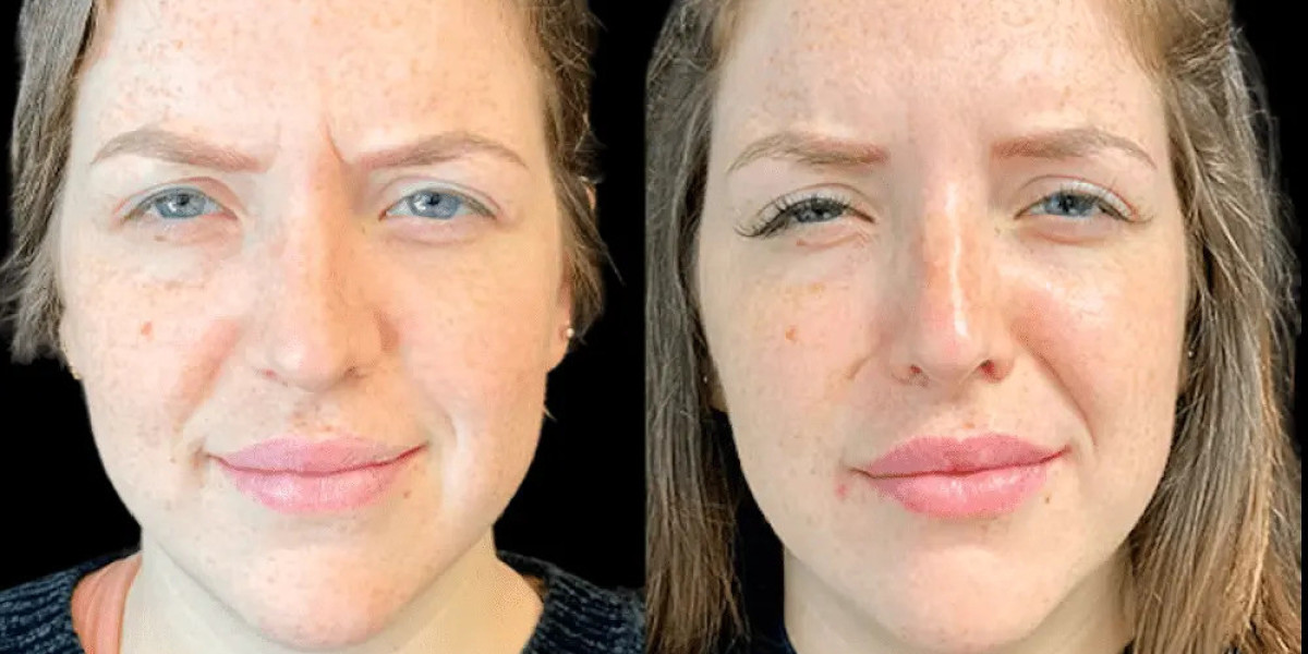 Best Doctors in Dubai for Botox in Jawline Slimming and Face Contouring