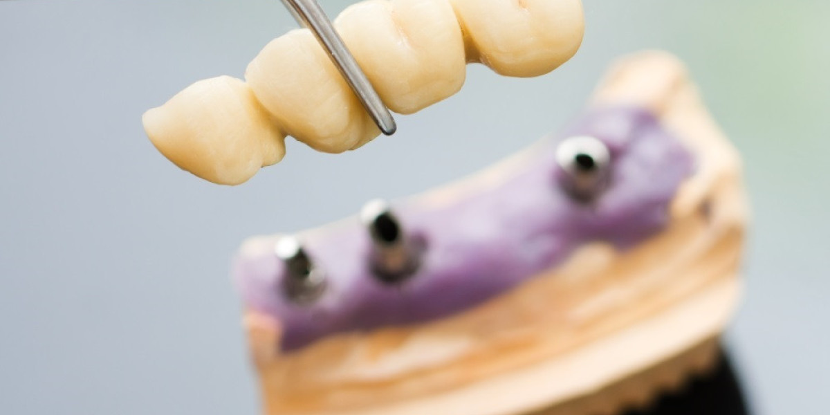 Understanding Full-Arch Implant Systems for Extensive Tooth Loss