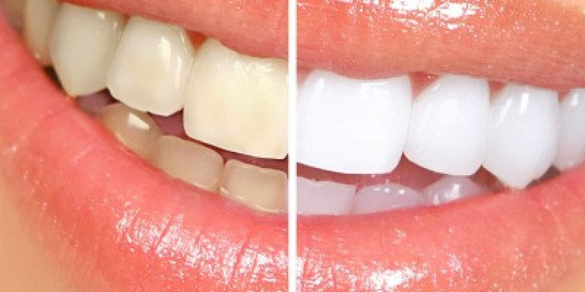 Teeth Whitening in Islamabad for Coffee & Tea Stains