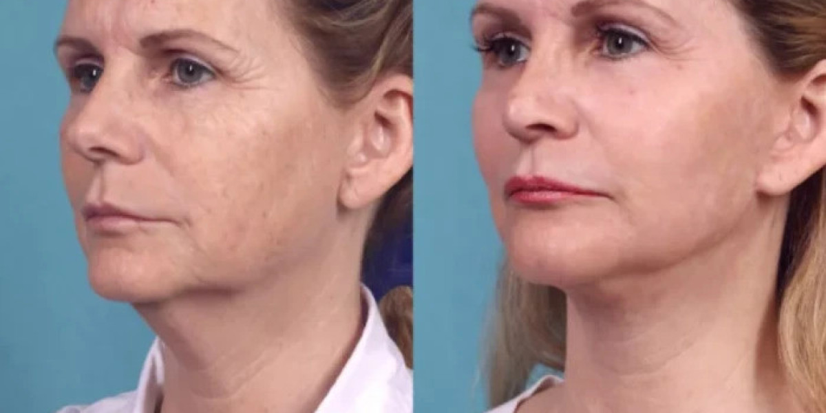 Advanced Chemical Peel Treatments in dubai Explained