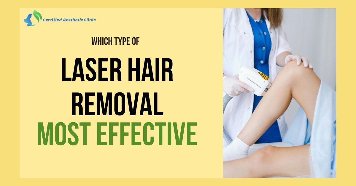 Which Type of Laser Hair Removal Is the Most Effective?