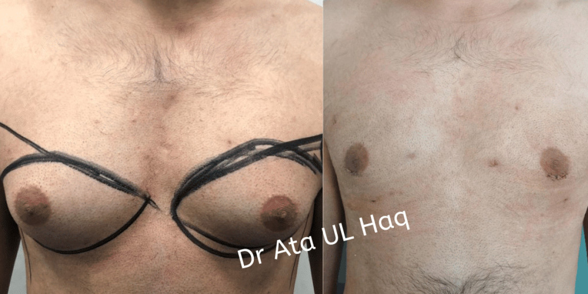 Why Choose Gynecomastia Surgery in Pakistan