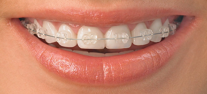 Braces in Nagpur