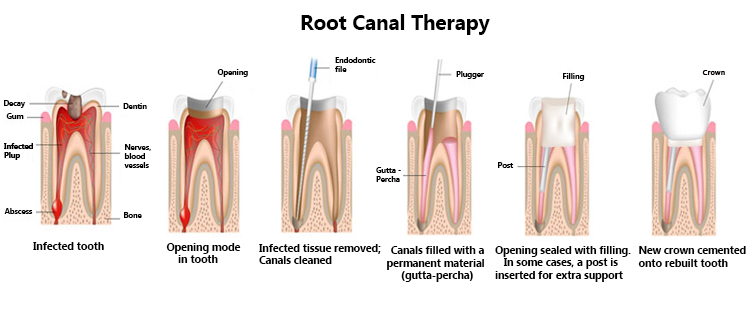 Painless Root Canal Treatment in Nagpur