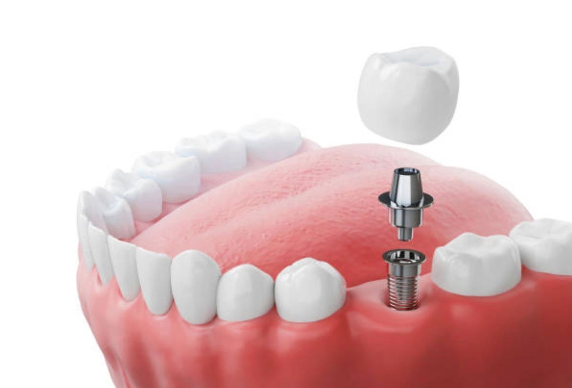Restore Your Smile with Dental Implants in Mount Roskill, Auckland — A Permanent Solution for Missing Teeth | by Stoddard dental Square | Jul, 2026 | Medium