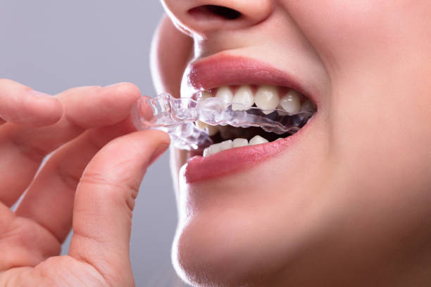 A Modern Guide to Clear Smile Transformation: What You Should Know Before Choosing Invisalign – Evergreenorthoga