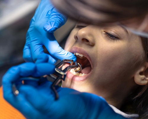 Simple Surgical Tooth Extractions in Lowell | Smiley Dental