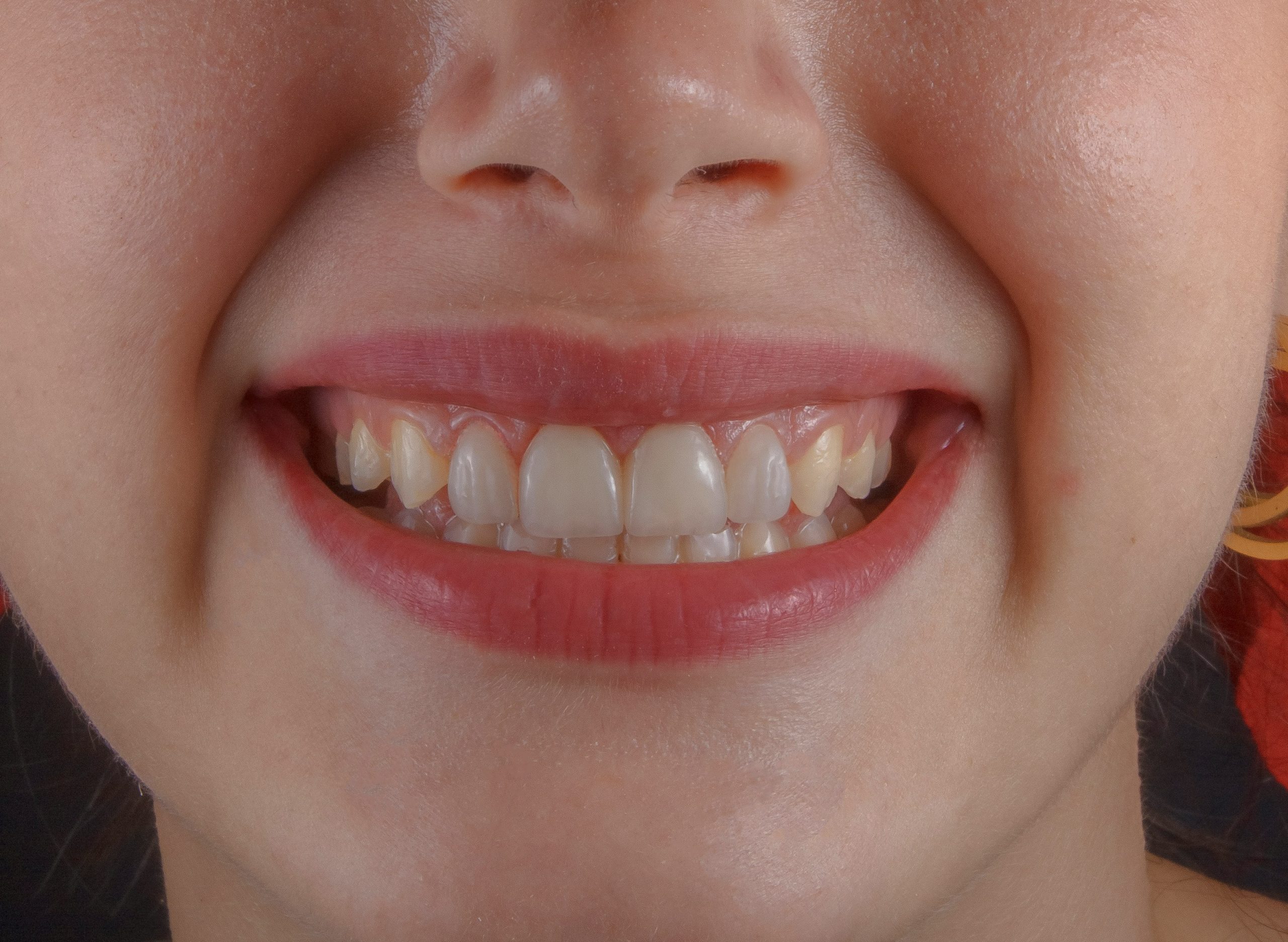 Laser Dental Cleaning In Villivakkam, Mogappair, Chennai