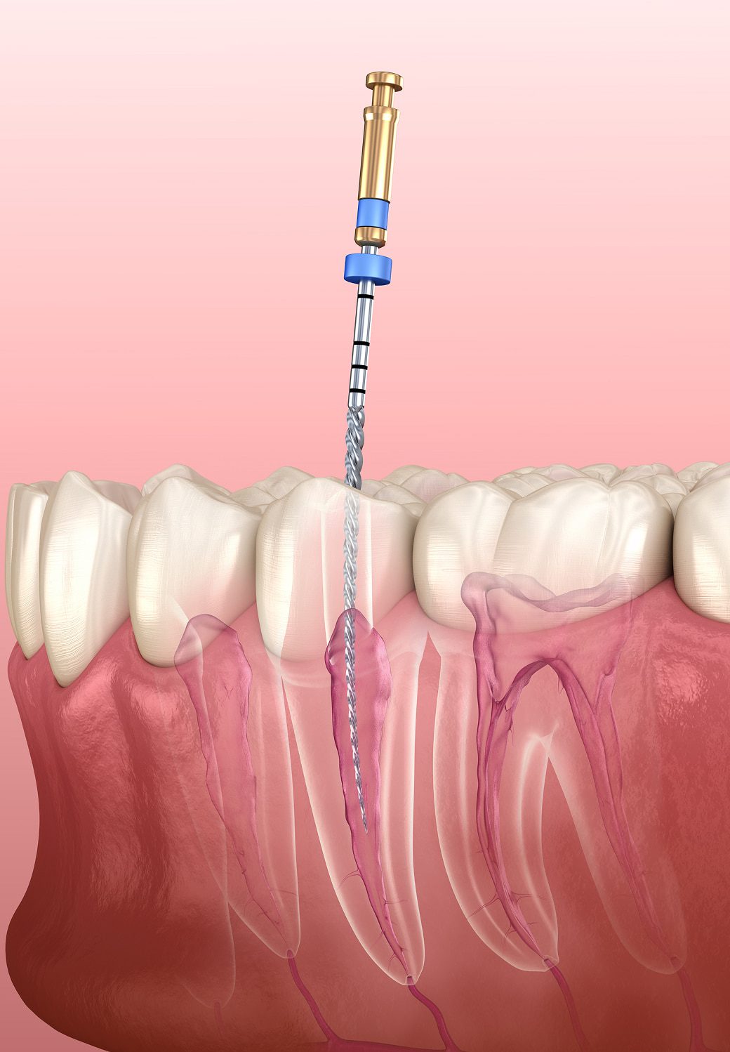 Tooth Pain That Won’t Go Away? How Root Canal Treatment Can Save Your Natural Smile – Telegraph
