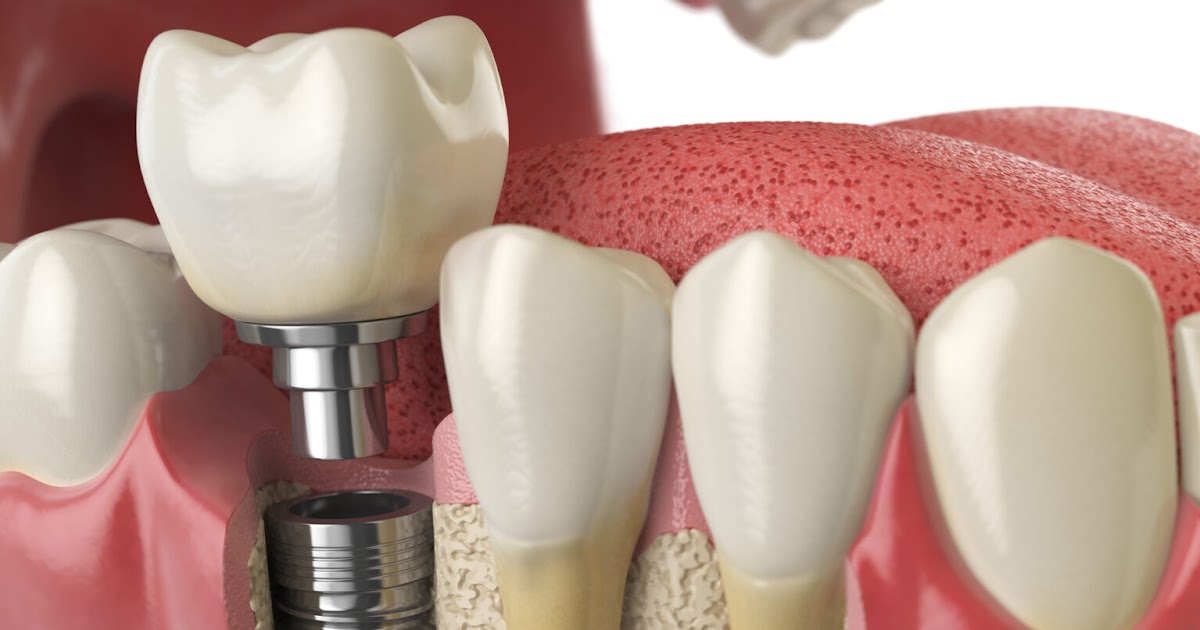 Transform Your Smile with Affordable Dental Implants in Bergen County NJ