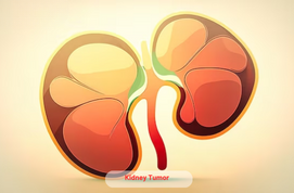 Kidney Tumor: Symptoms, Diagnosis & Treatment Options