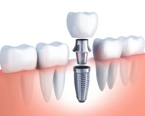 Dental Implants – Restore Your Smile with Confidence