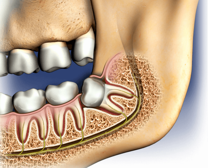 When Do You Need Wisdom Tooth Removal? Choosing a Dental Clinic in Noida | Plustibe Articles