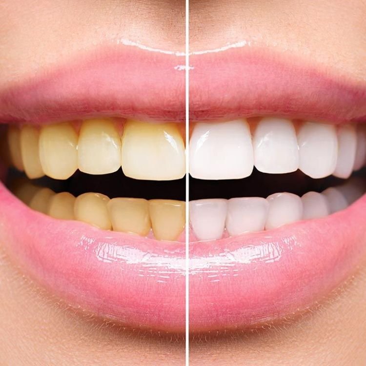Teeth Whitening Phillipsburg NJ | Teeth Whitening Treatment