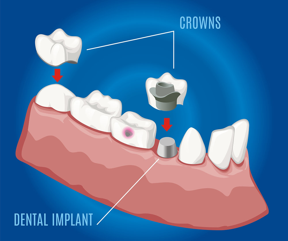 Why Some Teeth Need Crowns After Root Canal Treatment