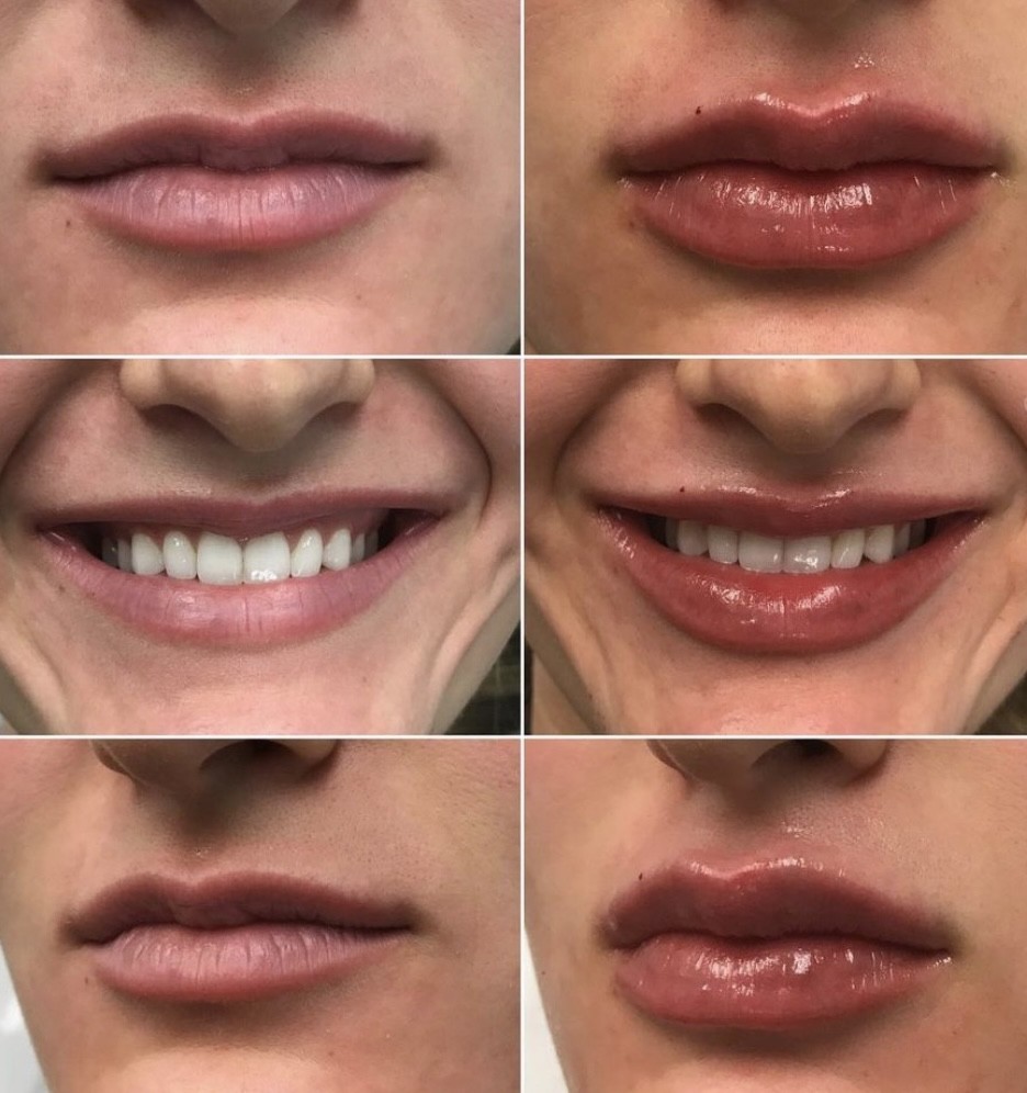 Lip Filler Augmentation | Azani Medical Spa