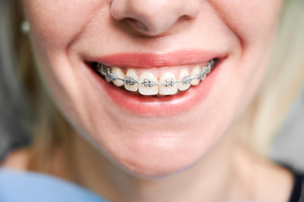 What to Expect in the First Week After Getting Braces – Daily Journal  Info