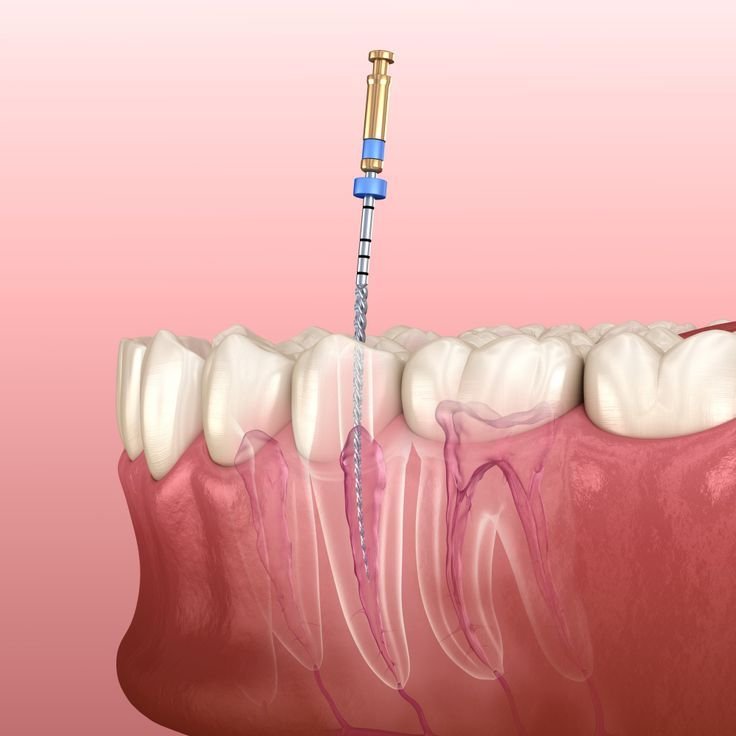 Root Canal Treatment Phillipsburg, NJ | Root Canal Dentist