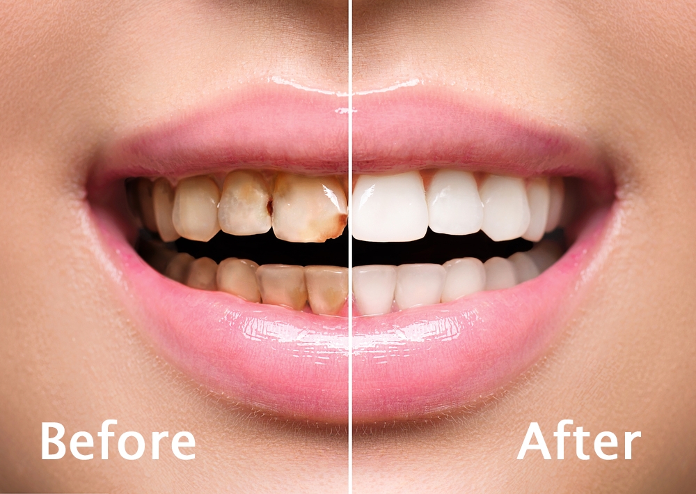 Teeth Scaling & Polishing | Gum Care Treatment